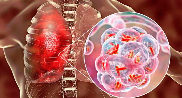 Agradece Cuba a Brasil asistencia en lucha contra la tuberculosis