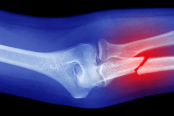 Células convertibles en hueso podrían ser clave para curar fracturas graves