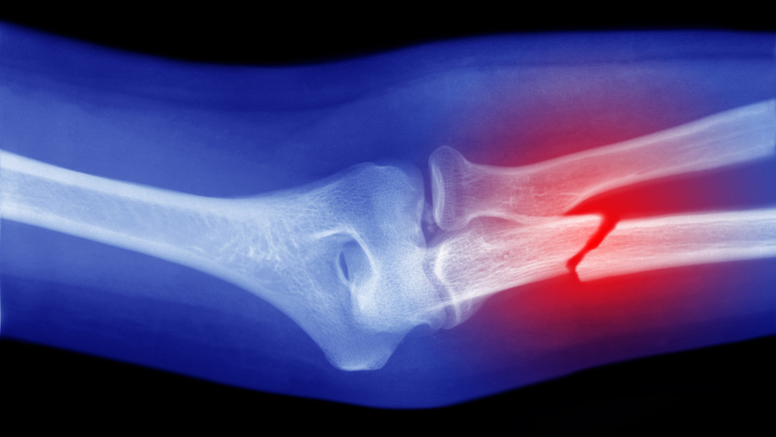 Células convertibles en hueso podrían ser clave para curar fracturas graves