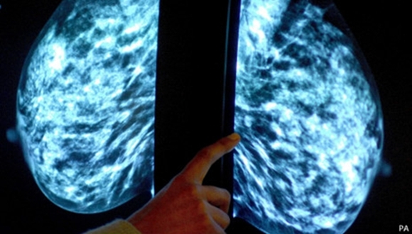 Anticuerpo conjugado muestra superioridad sobre quimioterapia estándar en cáncer de mama precoz