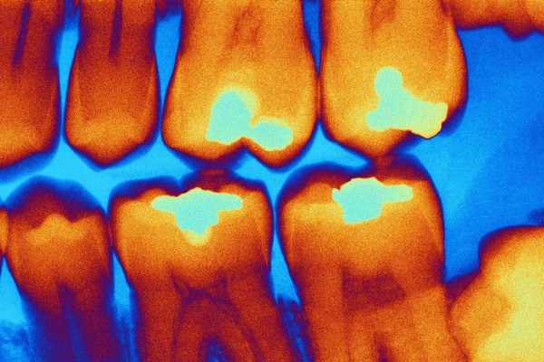 Científicos rusos crean dispositivo capaz de diagnosticar las caries en tiempo real