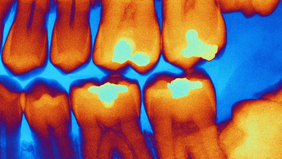 Científicos rusos crean dispositivo capaz de diagnosticar las caries en tiempo real