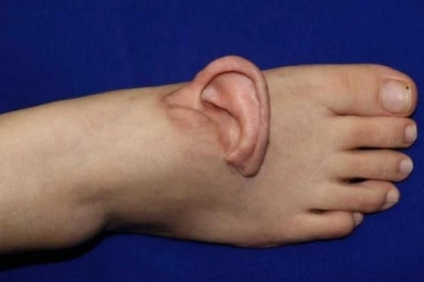 Milagro médico: mujer china lleva su oreja en el pie durante cinco meses antes de ser reimplantada