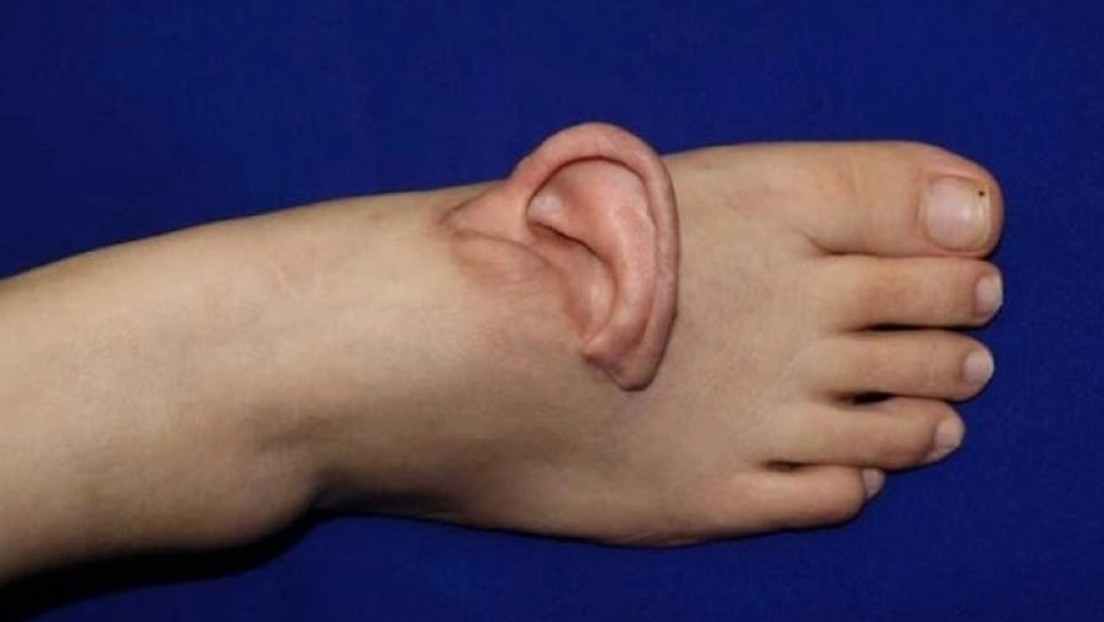 Milagro médico: mujer china lleva su oreja en el pie durante cinco meses antes de ser reimplantada