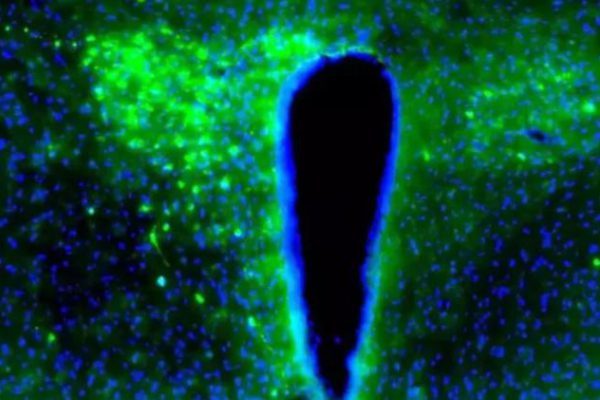 El cáncer interrumpe el ritmo natural del cerebro