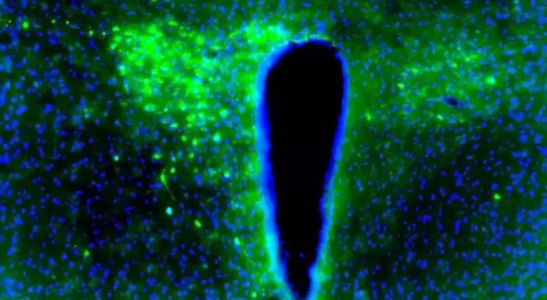 El cáncer interrumpe el ritmo natural del cerebro